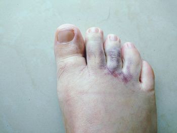 Low section of person with injured foot
