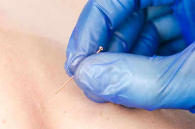 Cropped hand of physiotherapist applying acupuncture needle on skin to patient