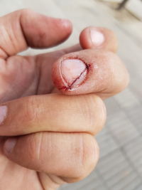 Cropped hand of person with injured nail