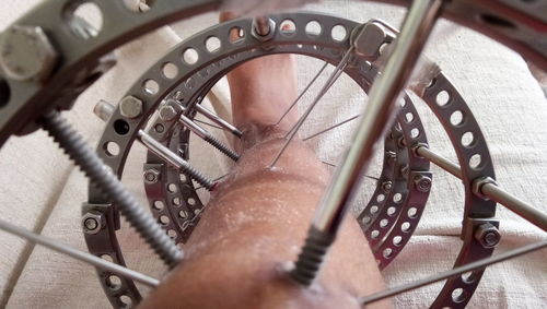 Close-up of external fixator on human leg