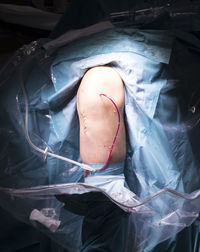 Midsection of patient with knee surgery in hospital ward