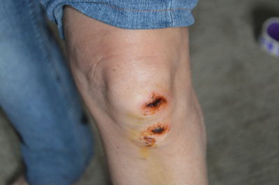 The wound about the fall on the asphalt on the body of a the woman