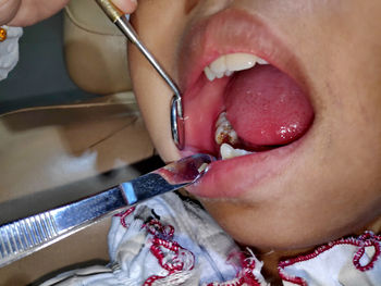 Cropped hand of dentist examining patient