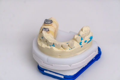 Dental casting, gypsum teeth model