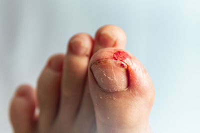 Close-up of bleeding toenail against wall