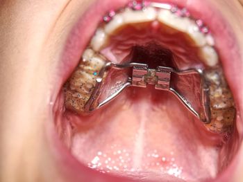 Kid wearing orthodontic palatal expanding trainer. invisible braces aligner. birth dental deffect