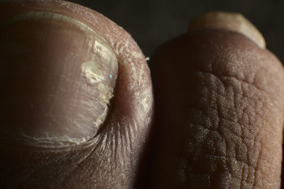 Toenail, infected with fungal onychomycosis