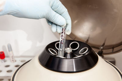 Scientist preparing a peritoneal fluid sample for cytology analysis in the laboratory. 