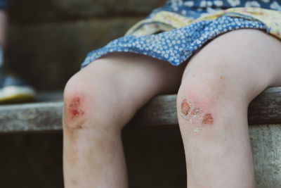 Midsection of girl with injured legs