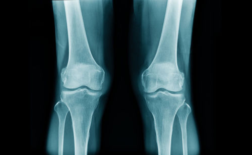 Medical x-ray image of knees and legs