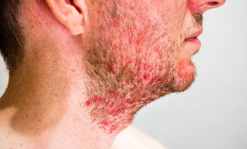 Midsection of man with beard infection against gray background