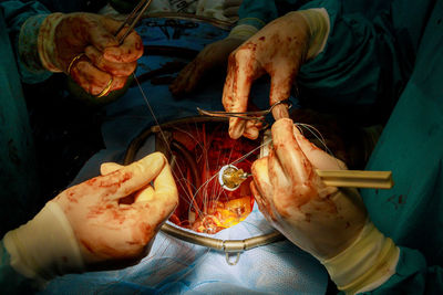 Midsection of surgeons performing surgery at operating room