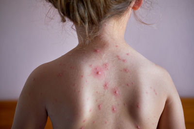 Rear view of shirtless girl with chickenpox