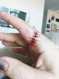Cropped hand of woman with stitches on wound