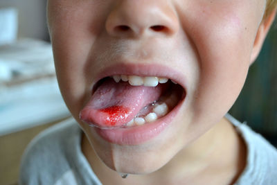 Child's bitten tongue