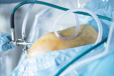 Close-up of equipment on patient knee during surgery