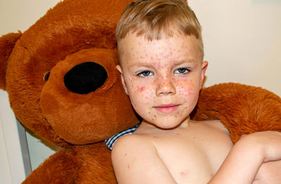 Varicella virus or chickenpox bubble rash on child