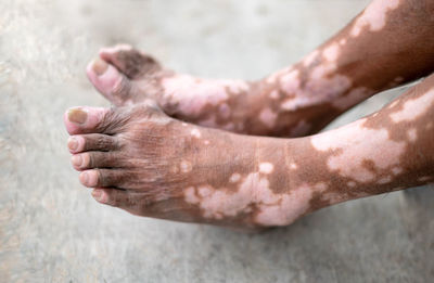 The old man's leg with a skin condition that causes loss of melanin vitiligo disorder.