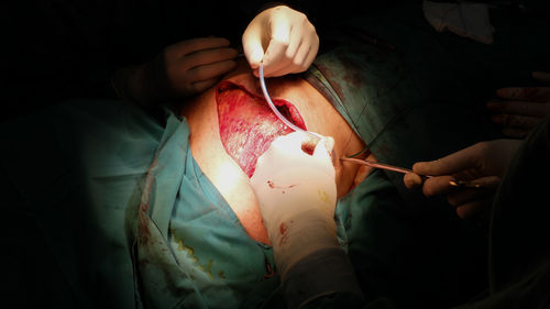 Cropped hands of doctor performing surgery on patient at hospital