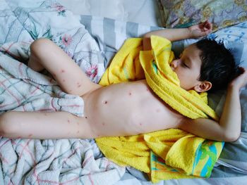 High angle view of shirtless boy with towel suffering from chickenpox on bed