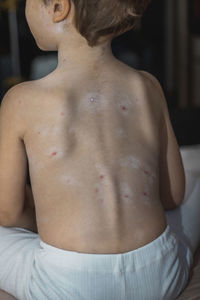Rear view of boy infected with chickenpox 