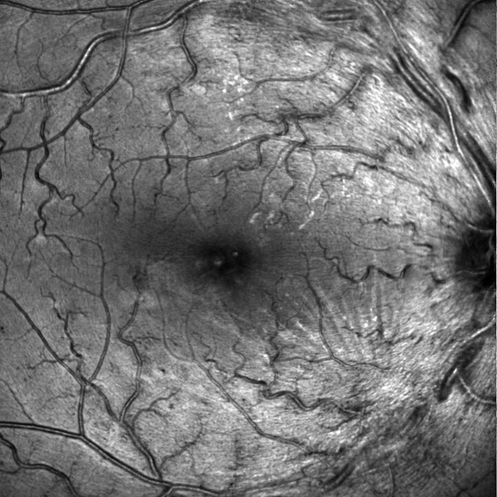 Epiretinalmembrane