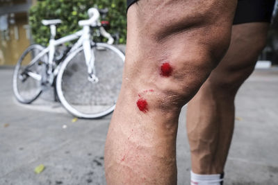 Close-up of wounded man knee