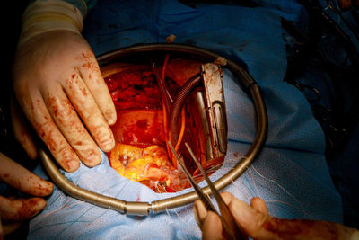 Cropped hand of surgeon operating patient at hospital