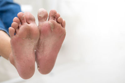 Close-up of peeling off and cracked foot due to an allergic chemical reaction.