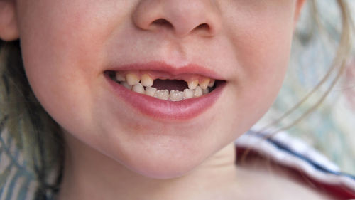Close-up of a child's mouth without two upper deciduous teeth toothless smile of a 6-7 year old girl