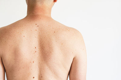 Pigmentation. close up detail of the bare skin on a man back with scattered moles and freckles.