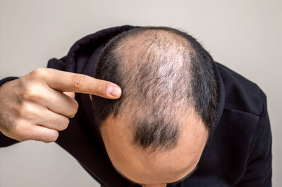 Close-up of man pointing at receding hairline against beige background