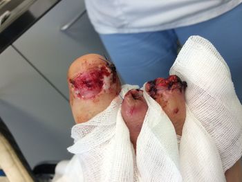 Cropped image of wounded leg with medical stitches