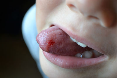 Child's bitten tongue