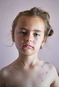 Portrait of shirtless girl with chickenpox