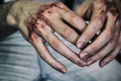 Cropped image of bruised hands of man