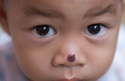 Close-up portrait of cute boy with nose injury