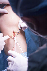 High angle view of doctor doing surgery in hospital