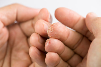 Close-up of bruised fingers