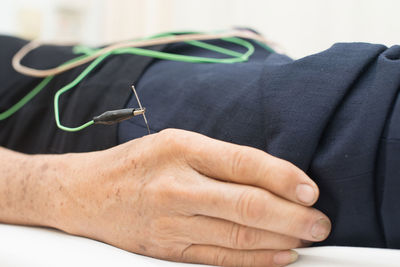 Midsection of man receiving acupuncture treatment