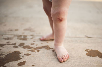 Low section of baby boy with wounded leg standing outdoors