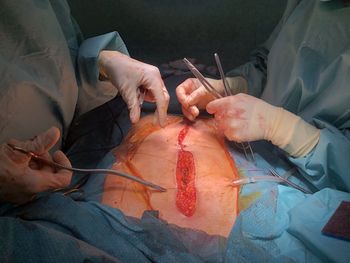 Midsection of surgeons operating patient at hospital
