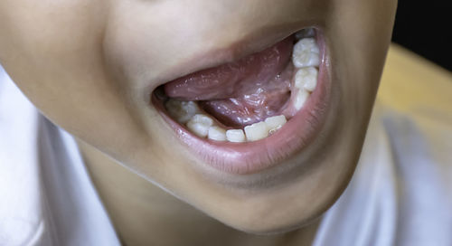 Close-up of boy with missing tooth