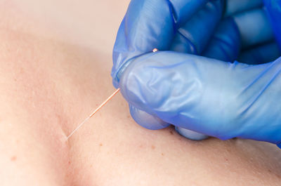 Cropped hand of physiotherapist applying acupuncture needle on skin to patient