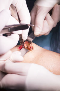 Cropped hands of surgeons doing patient surgery in hospital