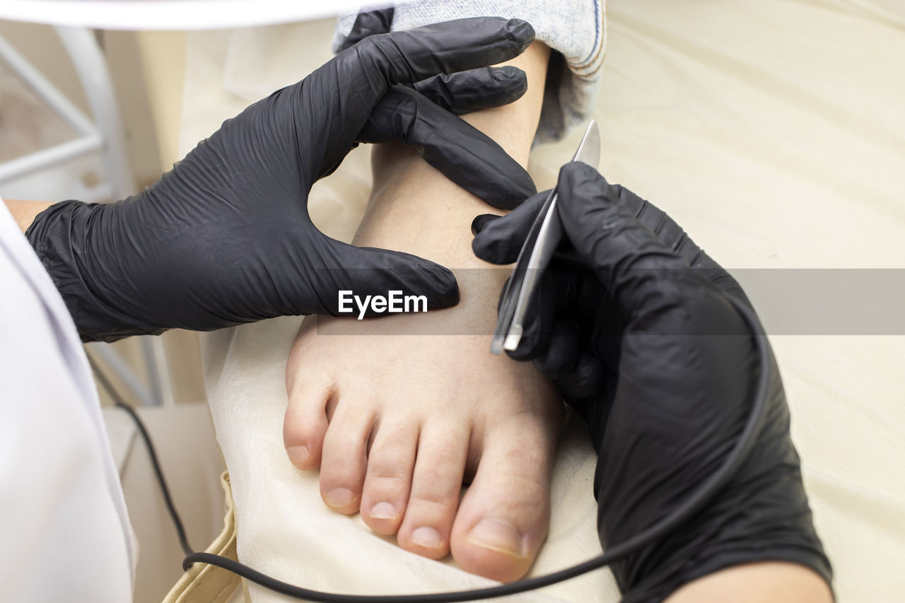 Cropped dermatologist doing hair removal electrolysis procedure on woman's toes, foot. electric