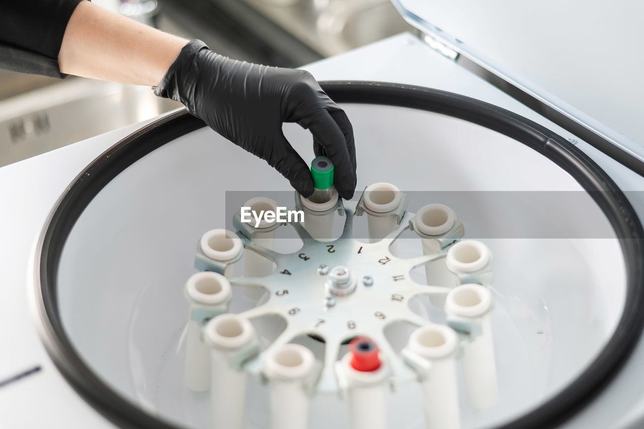 The doctor takes out a test tube with blood plasma from the centrifuge. plasma lifting procedure for