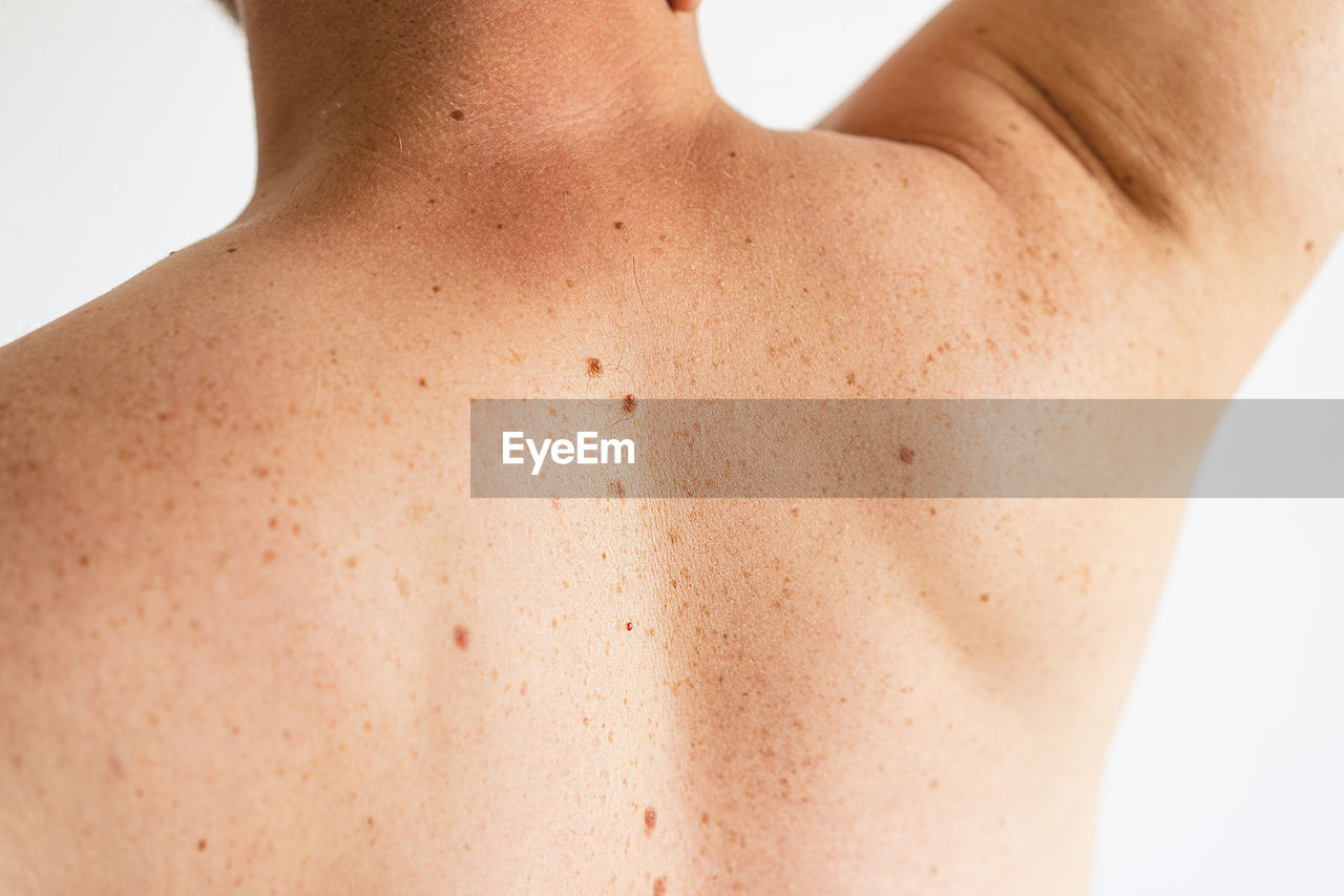 Pigmentation. close up detail of the bare skin on a man back with scattered moles and freckles.