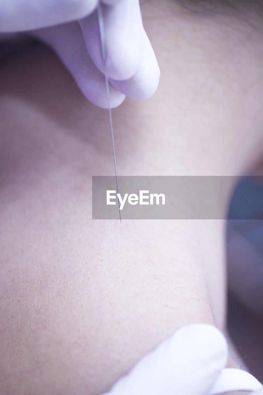 Cropped hand of acupuncturist applying acupuncture needle to woman neck