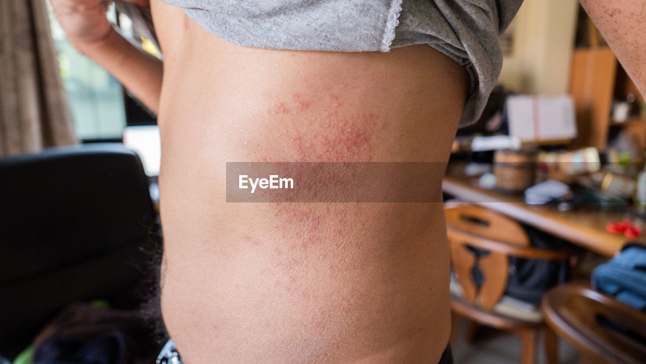 Midsection of man with dermatitis